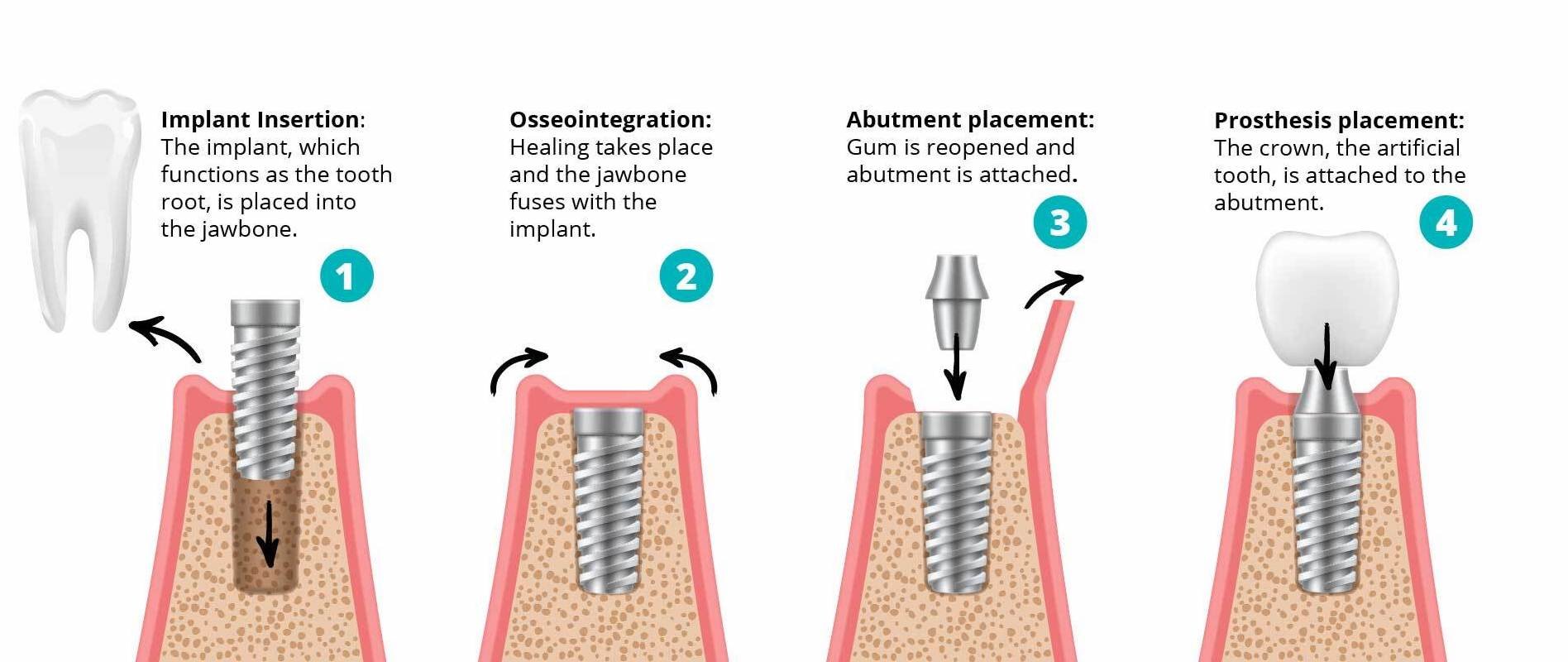 Dental Implants Replacing Missing Teeth Nuffield Dental